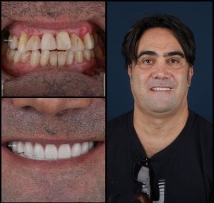 Avant et après facettes dentaires à Mira Clinic – sourire naturel après traitement