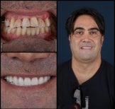 Avant et après facettes dentaires à Mira Clinic – sourire naturel après traitement