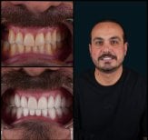 Résultat avant-après facettes dentaires à Mira Clinic (Mira Clinic SAĞLIK TURİZM ŞİRKETİ), sourire transformé