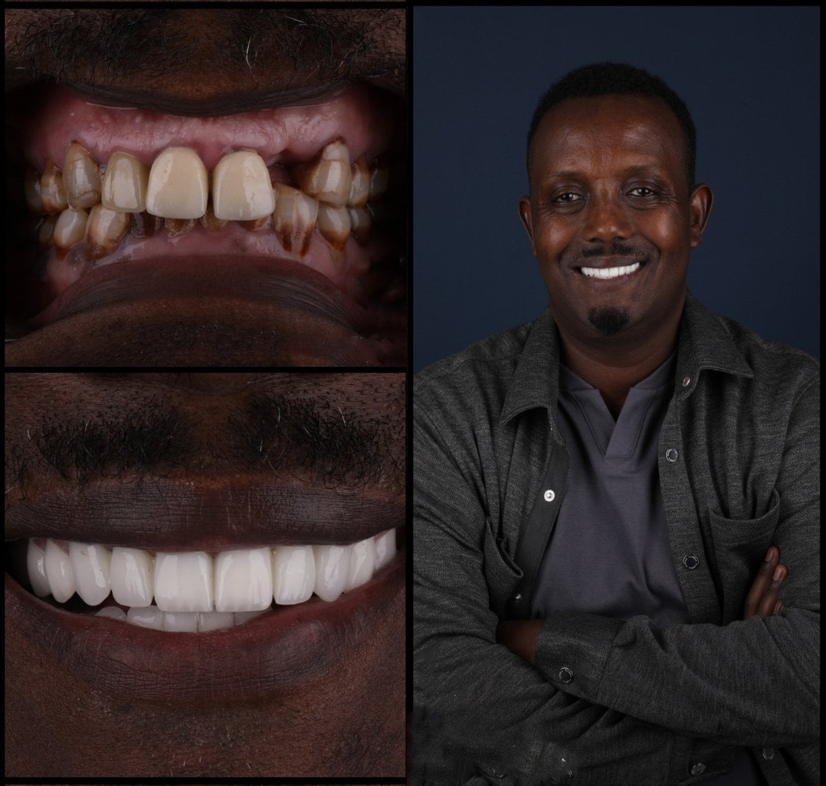 Resultados antes y después de smile makeover en Mira Clinic, carillas dentales para sonrisa
