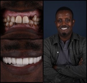 Smile makeover before and after results at Mira Clinic, dental veneers for improved smile