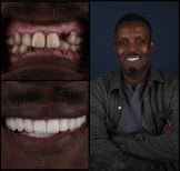 Smile makeover before and after results at Mira Clinic, dental veneers for improved smile