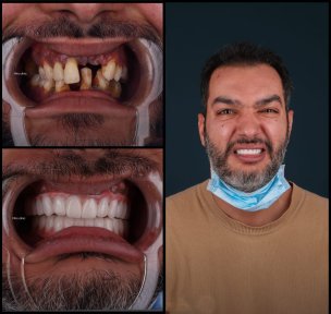 before-after photo all-on-4-dental-implants