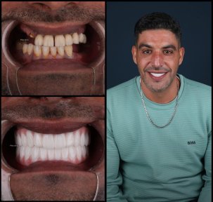 before-after photo all-on-4-dental-implants