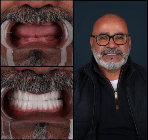 before-after photo all-on-4-dental-implants