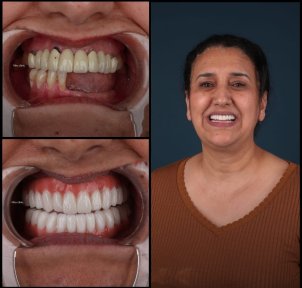 before-after photo all-on-4-dental-implants