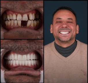 before-after photo all-on-4-dental-implants