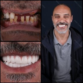 Smile makeover before and after results at Mira Clinic, full dental restoration transformation