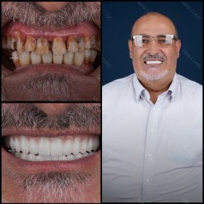Smile makeover before and after results at Mira Clinic, dental restoration and veneers transformation