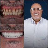 Smile makeover before and after results at Mira Clinic, dental restoration and veneers transformation