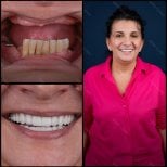 Smile makeover before and after results at Mira Clinic, dental veneers for natural smile transformation