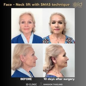 before-after photo tightening-of-facial-skin-facelift