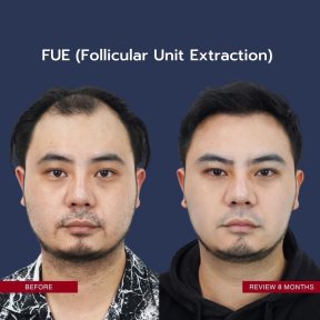 before-after photo hair-transplant