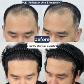 before-after photo hair-transplant