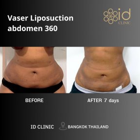before-after photo vaser-liposuction