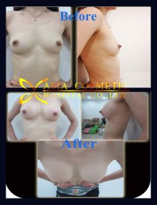 before-after photo breast-augmentation-with-fat-transfer