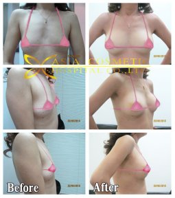 before-after photo breast-augmentation-with-fat-transfer