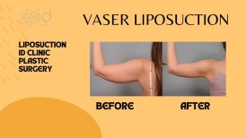 Before and after Vaser liposuction arm results at ID Clinic Bangkok, visible fat reduction