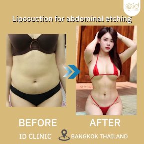 Before and after abdominal etching liposuction results at ID Clinic Bangkok, toned waistline