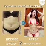 Before and after abdominal etching liposuction results at ID Clinic Bangkok, toned waistline