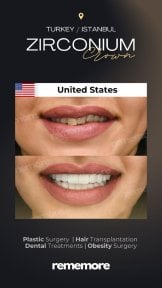 before-after photo clear-aligners