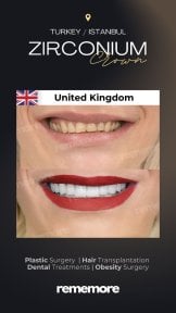 before-after photo clear-aligners