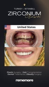 before-after photo clear-aligners