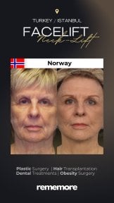 before-after photo rhinoplasty-nose-job