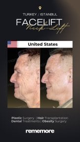 before-after photo rhinoplasty-nose-job