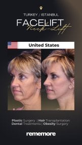before-after photo rhinoplasty-nose-job