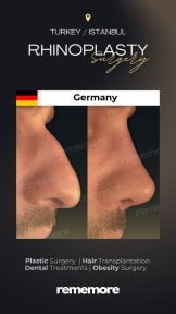 before-after photo rhinoplasty-nose-job