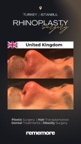 before-after photo rhinoplasty-nose-job