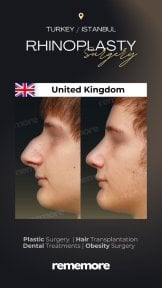 before-after photo rhinoplasty-nose-job