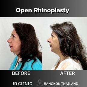 before-after photo rhinoplasty-nose-job