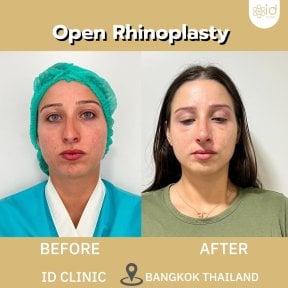 before-after photo rhinoplasty-nose-job