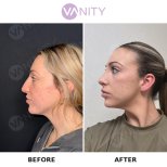 نتائج عملية تجميل الأنف قبل وبعد في VANITY COSMETIC SURGERY HOSPITAL، إعادة تشكيل الأنف