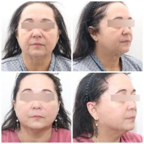 before-after photo mini-facelift