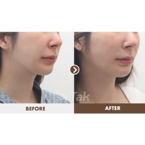 before-after photo mini-facelift