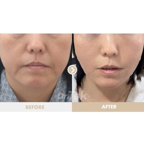 before-after photo mini-facelift