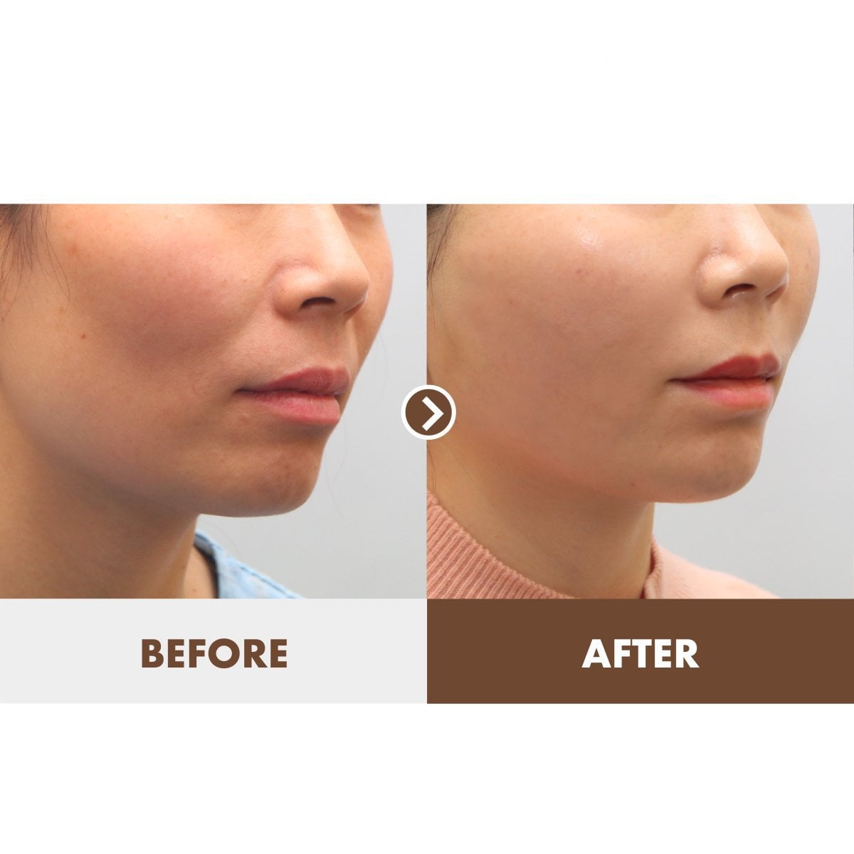 Resultado de minilifting facial antes y después en Dr. Tak Plastic Surgery, contorno visible
