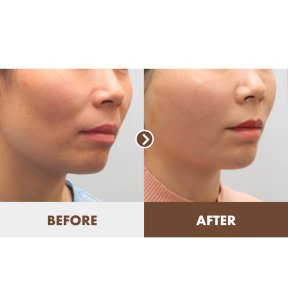 before-after photo mini-facelift