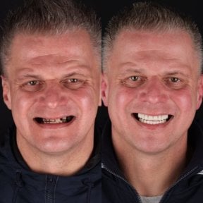 before-after photo all-on-4-dental-implants