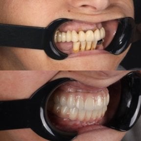 before-after photo all-on-4-dental-implants