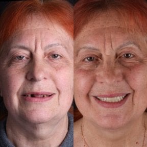 before-after photo all-on-4-dental-implants