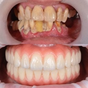 before-after photo all-on-4-dental-implants