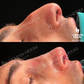 before-after photo open-rhinoplasty