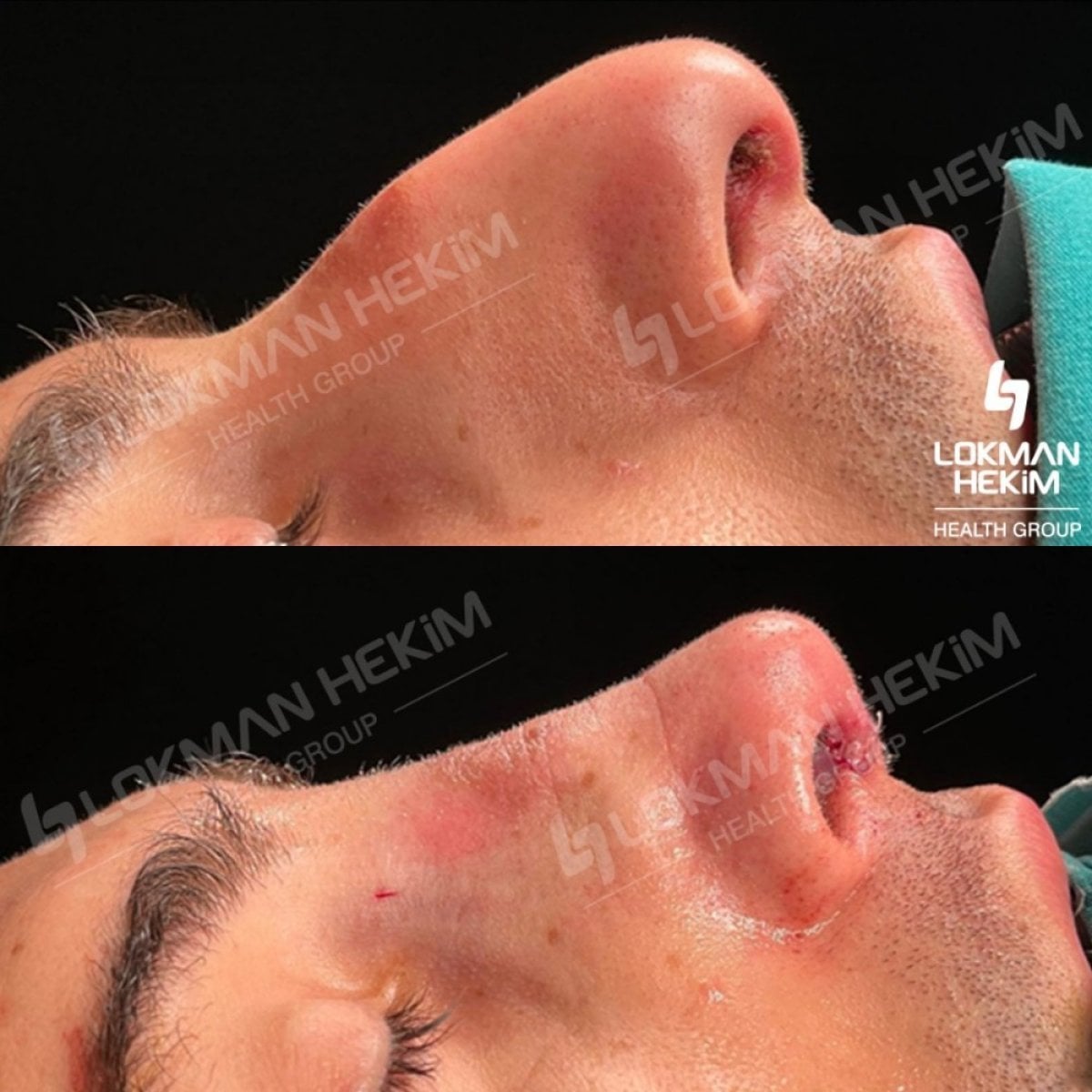 Resultados de rinoplastia masculina antes y después en Lokman Hekim Istanbul Hospital, remodelación nasal