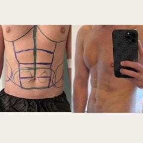 before-after photo 360-liposuction