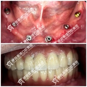 Результаты до и после имплантации зубов в Wuhan Yiya Simei Dental Hospital, восстановленная улыбка