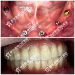 Результаты до и после имплантации зубов в Wuhan Yiya Simei Dental Hospital, восстановленная улыбка